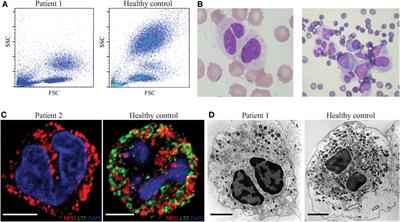 CEBPE-Mutant Specific Granule Deficiency Correlates With Aberrant Granule Organization and Substantial Proteome Alterations in Neutrophils